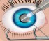Phẫu thuật mắt (802 lượt chơi)